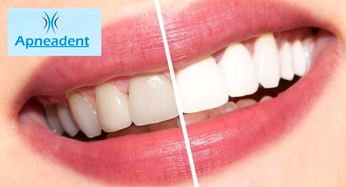 Este verano, deslumbra con una sonrisa perfecta: Limpieza bucal y Blanqueamiento Dental LED.