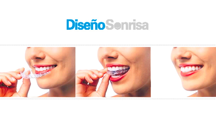 Limpieza, pulido de manchas o blanqueamiento con férula en Diseño Sonrisa (Almería y Roquetas).