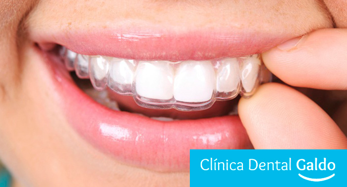 Olvídate de la tensión maxilar y el desgaste dental: Férula de Descarga Semirrígida + Funda