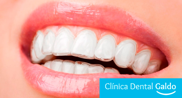 Olvídate de la tensión maxilar y el desgaste dental: Férula de Descarga Semirrígida + Funda
