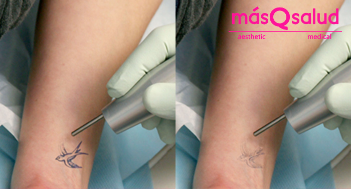 Eliminación de tatuajes con Ténica Q-Switched: ¡Y dile adiós para siempre!