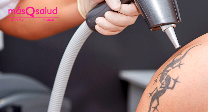 Eliminación de tatuajes con Ténica Q-Switched: ¡Y dile adiós para siempre!