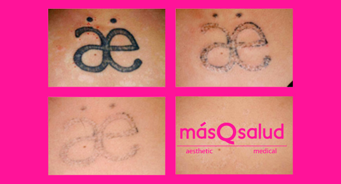 Eliminación de tatuajes con Ténica Q-Switched: ¡Y dile adiós para siempre!
