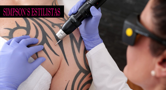 Eliminación de tatuaje o manchas en la piel con Láser Neodimio Yag Q-Switch...¡Y hasta nunca!