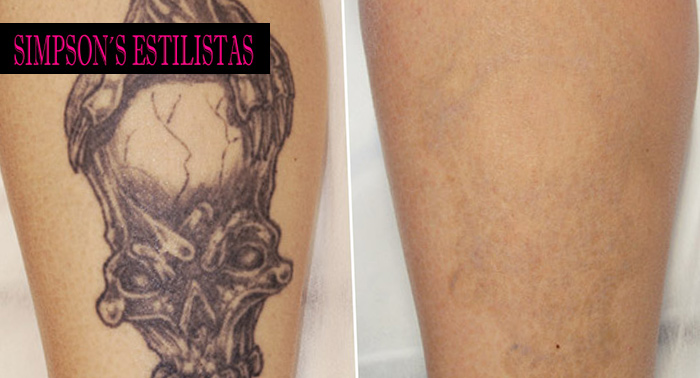 Eliminación de tatuaje o manchas en la piel con Láser Neodimio Yag Q-Switch...¡Y hasta nunca!