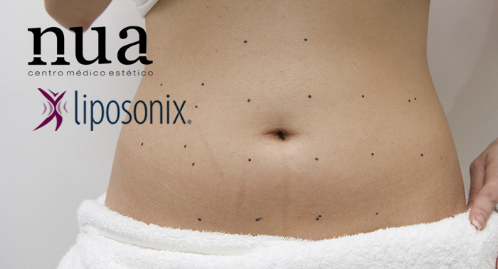 El Tratamiento Revolucionario contra la grasa localizada: Liposonix. ¡Di NO al quirófano!