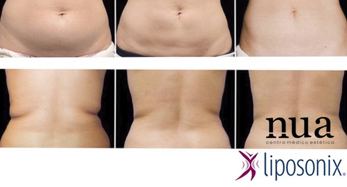 El Tratamiento Revolucionario contra la grasa localizada: Liposonix. ¡Di NO al quirófano!