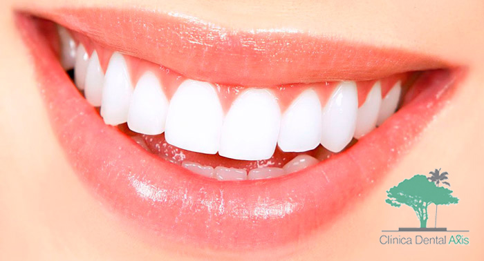 ¡Brilla con tu sonrisa! Blanqueamiento Dental LED + Limpieza Bucal con Pulido y Fluorización