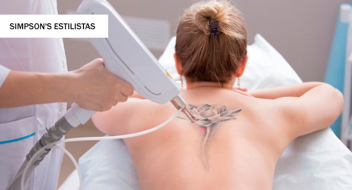 ¡Despídete de las imperfecciones! Eliminación de Tatuajes o Manchas en la Piel con Láser