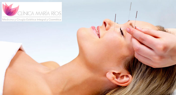 ¡Reduce signos de edad! Tratamiento de Lifting Facial con Acupuntura en Clínica María Ríos