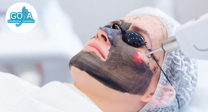 ¡Regenera y rejuvenece tu piel! 1, 2 o 3 Sesiones de Láser Carbon Peel Facial