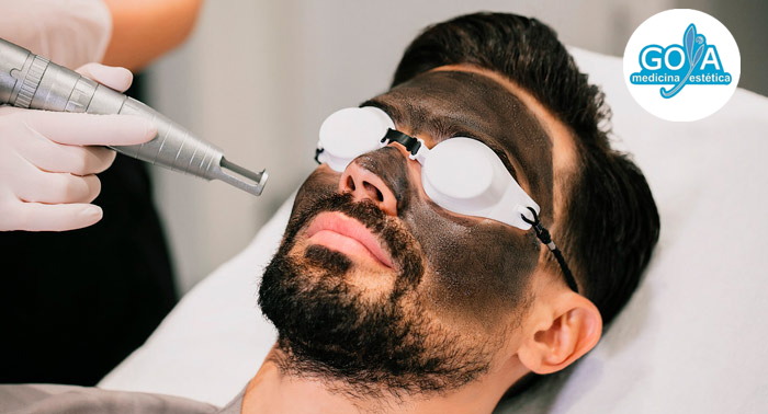 ¡Regenera y rejuvenece tu piel! 1, 2 o 3 Sesiones de Láser Carbon Peel Facial