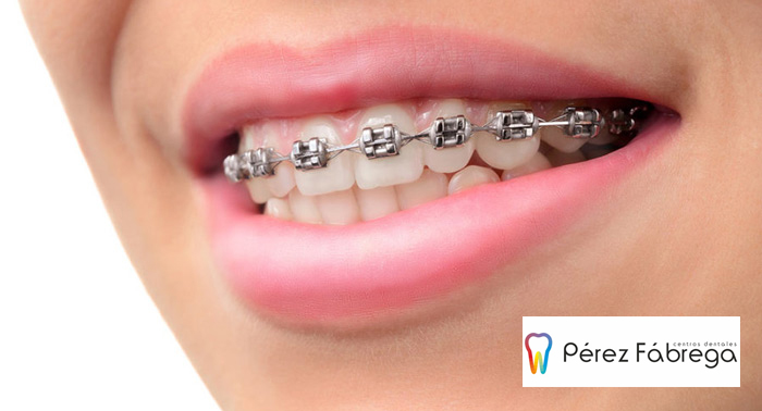 ¡Luce sonrisa! Ortodoncia + Radiografías + Estudio + Brackets + 3 Revisiones + Limpieza