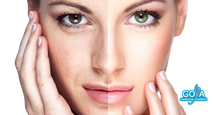 ¡Luce perfecta! Lifting Sin Cirugía: 1, 2 o 3 Sesiones de Radiofrecuencia Facial