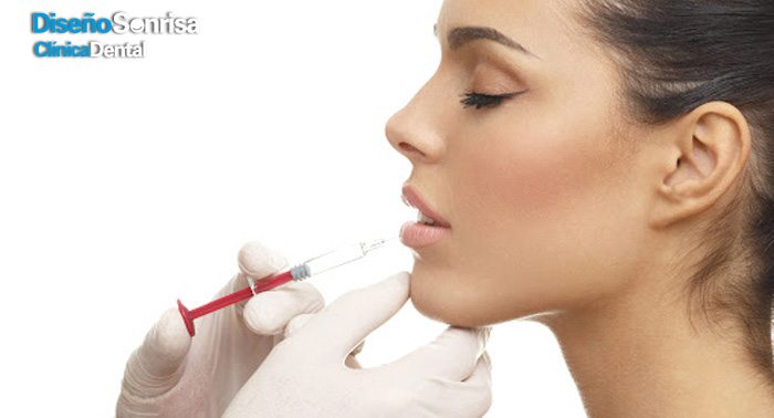 ¡Labios perfectos! Relleno de Labios con Ácido Hialurónico en Clínica Dental Diseño Sonrisa