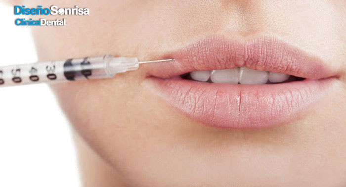 ¡Labios perfectos! Relleno de Labios con Ácido Hialurónico en Clínica Dental Diseño Sonrisa