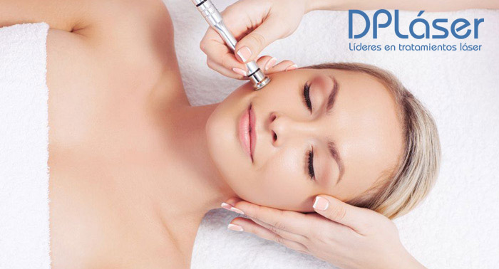 1 o 3 Sesiones de Peeling de Carbón Activo o Radiofrecuencia Facial Vela Smooth