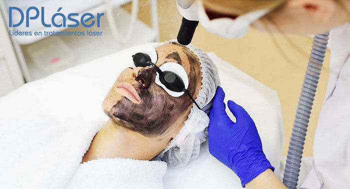 1 o 3 Sesiones de Peeling de Carbón Activo o Radiofrecuencia Facial Vela Smooth