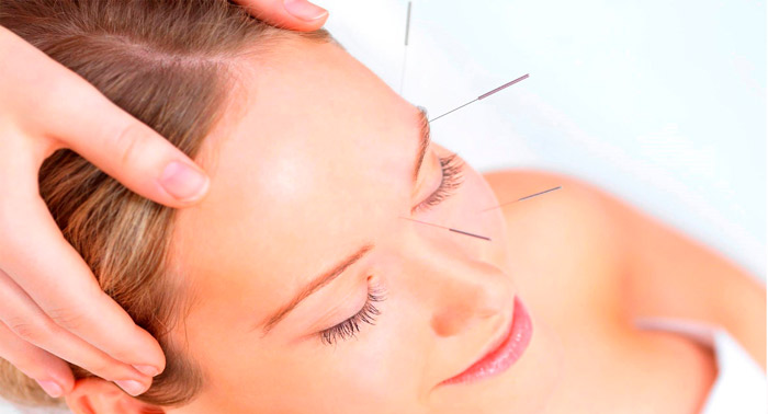 Sorpréndete con este Lifting Facial con Acupuntura para reducir los signos de la edad