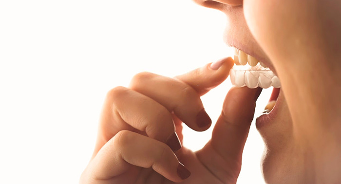 Cuida tu dentadura o la de tu familia con esta Férula de Descarga Dental