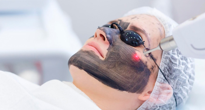 ¡Regenera y rejuvenece tu piel! 1, 2 o 3 Sesiones de Láser Carbon Peel Facial