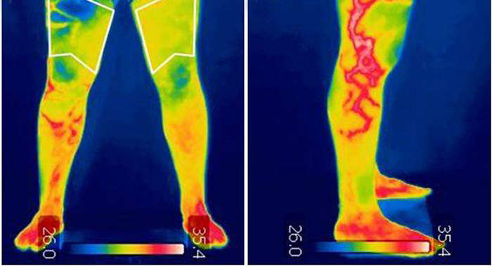 ¡Luce cuerpo perfecto! Presoterapia + Diagnóstico Corporal con Cámara Termográfica 
