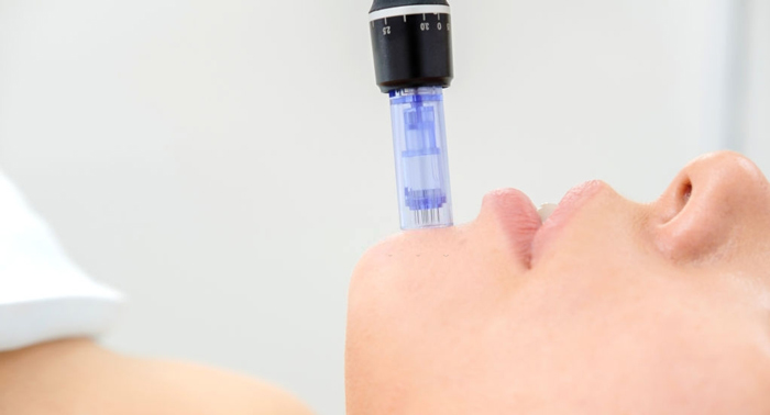 Piel perfecta con Dermapen: Cóctel de Vitaminas. Borra las arrugas y elimina las manchas