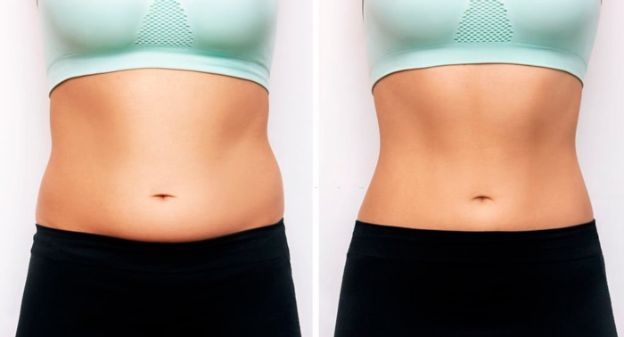 Vientre plano y cuerpo esculpido con Bodyshock de Mesoestetic +  Liposonix