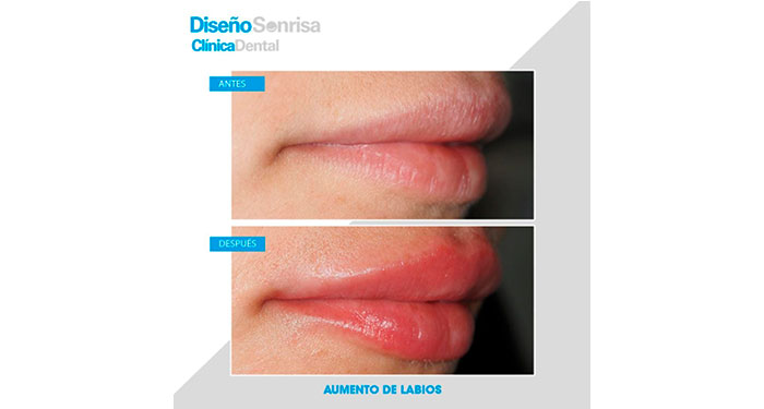 ¡Labios perfectos! Relleno de Labios con Ácido Hialurónico en Clínica Dental Diseño Sonrisa