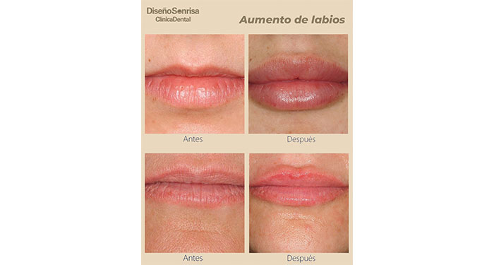 ¡Labios perfectos! Relleno de Labios con Ácido Hialurónico en Clínica Dental Diseño Sonrisa