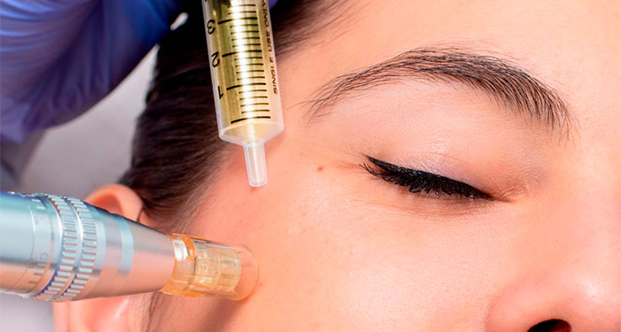 Piel perfecta este Verano: Exosomas con dermapen + Radiofrecuencia