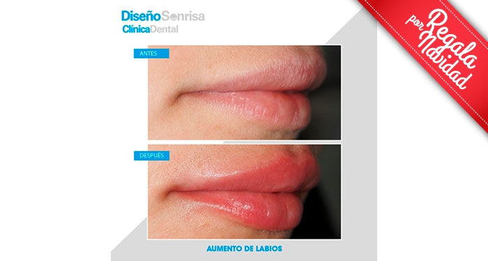 ¡Labios perfectos! Relleno de Labios con Ácido Hialurónico en Clínica Dental Diseño Sonrisa